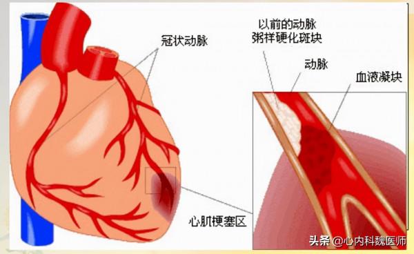 45歲男子心梗離世!醫生說:他有3次救命機會,可惜都錯過了 45歲男子心梗離世!醫生說:他有3次救命機會,可惜都錯過了