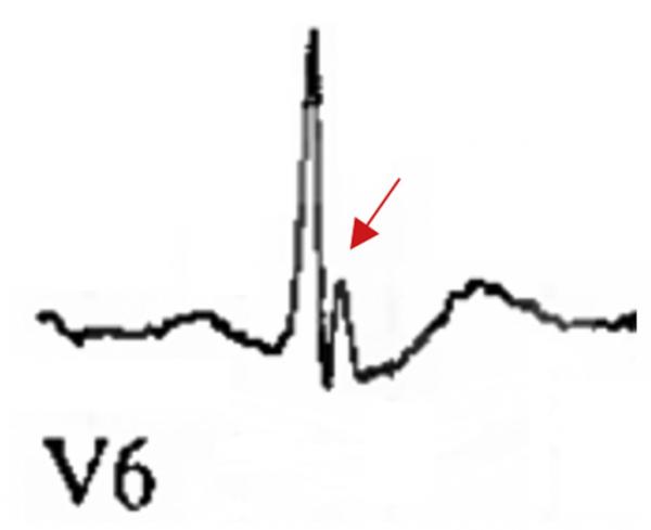 早期復極都是正常的嗎?一場驚險的心跳驟停帶來的啟示 早期復極都是正常的嗎?一場驚險的心跳驟停帶來的啟示