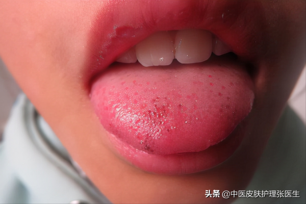 再分享一個黃褐斑經驗方：滋陰、解鬱、清熱，已經過驗證有效