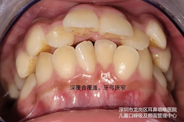 張口呼吸會長歪,用“閉嘴貼”?醫生:胡來! 張口呼吸會長歪,用“閉嘴貼”?醫生:胡來!