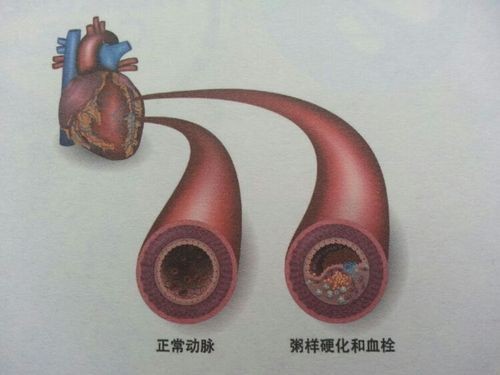 兩種中成藥，益氣復脈、活血化瘀、養陰生津，改善冠心病、心絞痛