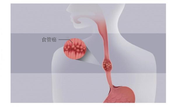 出現前胸或後背隱痛,別忽視了食管的問題 出現前胸或後背隱痛,別忽視了食管的問題