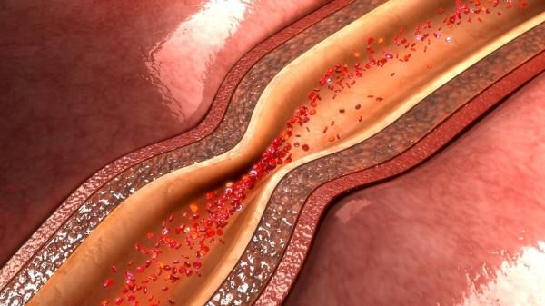 冠狀動脈粥樣硬化是冠心病前期，如何治療？做好三個堅持很關鍵