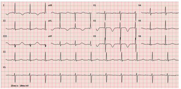 病例 &vert; 低鈣血癥型心肌病：一種罕見但可逆的疾病