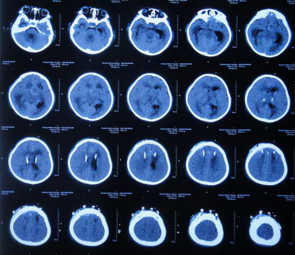 顱內生殖細胞瘤切除術後腦積水仍反覆,意識模糊,左側肢體偏癱 顱內生殖細胞瘤切除術後腦積水仍反覆,意識模糊,左側肢體偏癱