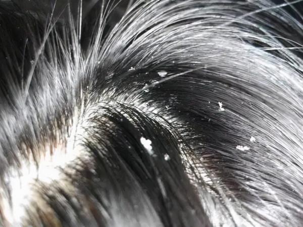 頭上總是長疙瘩，還時不時有膿包？很可能是這4種現象引起的