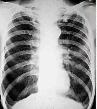 長期咳嗽、咳痰、胸悶氣短，可能是肺氣腫在“作怪”，別不當回事