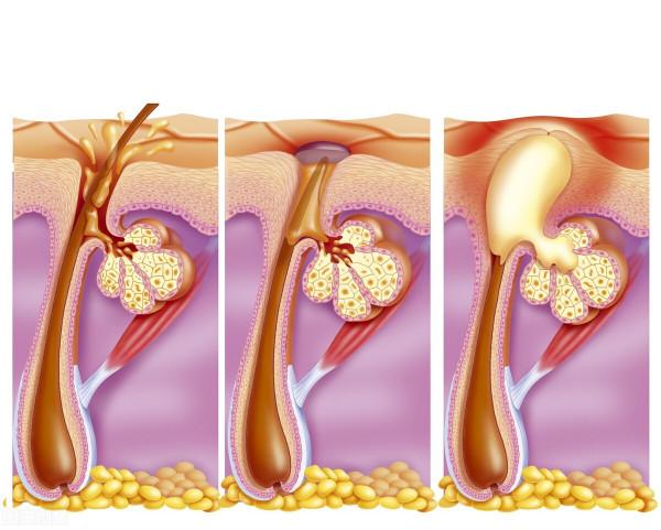青春痘、痤瘡應該怎麼治療？