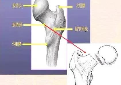 股骨頸骨折以後的我到底有多消極？