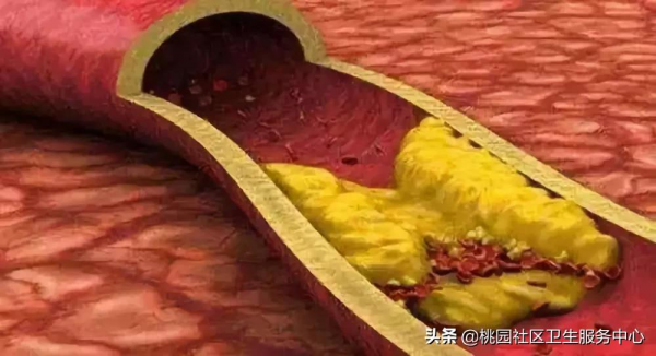 &OpenCurlyDoubleQuote;三高&rdquo;的危害你瞭解嗎？面對&OpenCurlyDoubleQuote;三高&rdquo;我們應該怎麼辦？