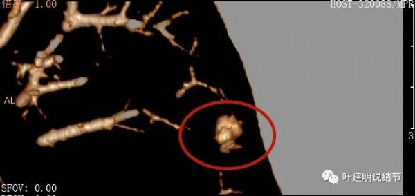 指南說小於5毫米的肺結節不需要隨訪，打臉來了