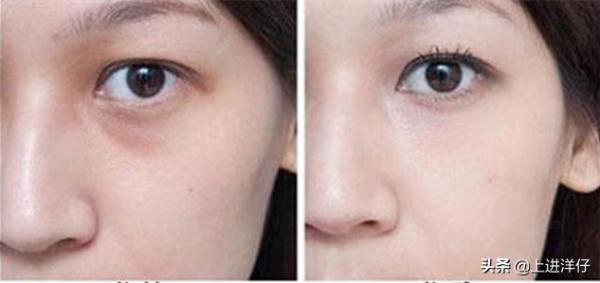 眼袋顯老怎麼辦？教你幾個小妙招輕鬆去除眼袋