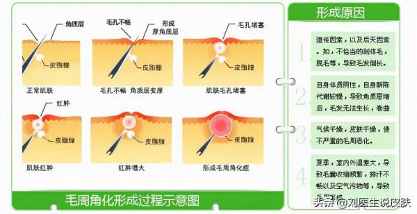 別人的面板光滑細膩，你的面板“雞皮”密密？這份自救指南請收好