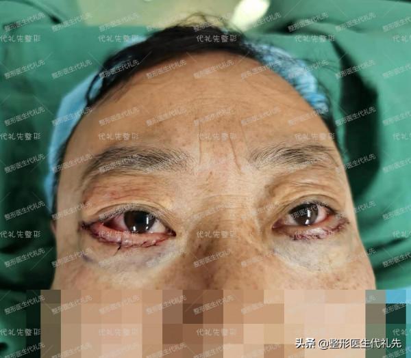 最值得35~70歲男士做的眼周年輕化術式－外路祛眼袋手術