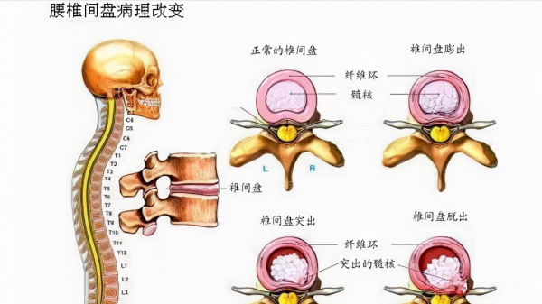 為啥出現腰腿痛,反覆治不好?這3個病因很常見,醫生告訴您真相 為啥出現腰腿痛,反覆治不好?這3個病因很常見,醫生告訴您真相