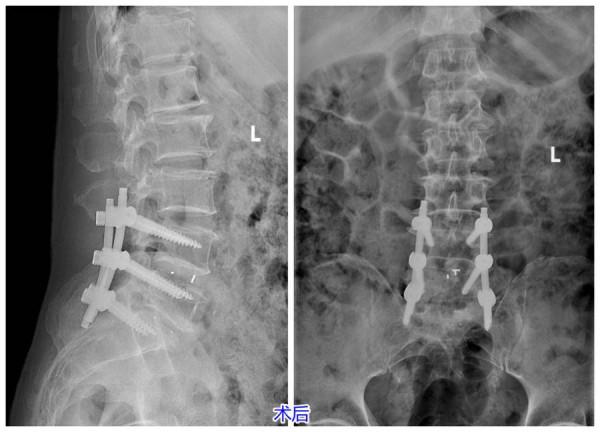 腰疼15年誤作“腰突症”治，南郊醫院確診“椎管狹窄”微創解除