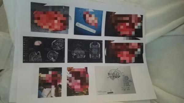 因為害怕死亡，美國小哥動手術切掉部分大腦：徹底消除恐懼感