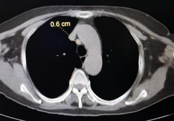 去醫院體檢，CT報告上那些不用過於擔心的診斷結果