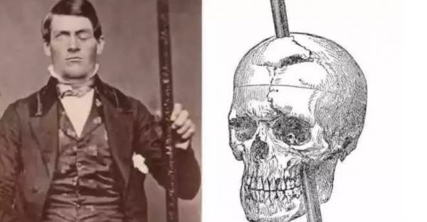 歐美醫療黑歷史，攪拌腦漿、切割腦組織，把人變成行屍走肉