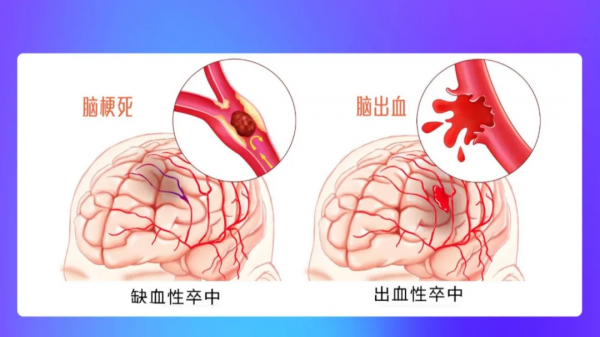 識別腦中風先兆,學會重要急救步驟,關鍵時刻真的能救命!——“323”系列科普 識別腦中風先兆,學會重要急救步驟,關鍵時刻真的能救命!——“323”系列科普