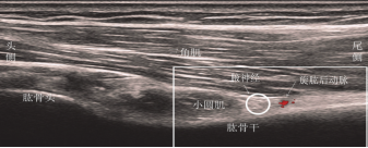 超聲引導下腋神經阻滯的研究進展