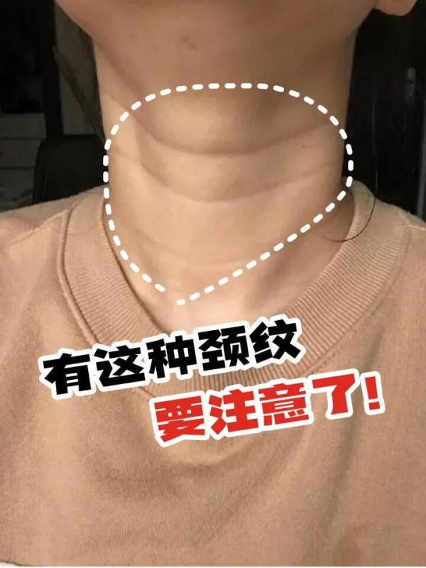 有這樣的頸紋要注意了！這樣做頸紋真的沒了
