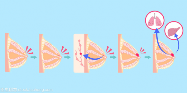 乳腺癌手術，該怎樣正確選擇？醫生告訴你