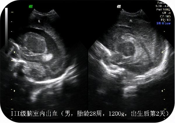 “綠色檢查”,護佑新生——新生兒顱腦超聲檢查 “綠色檢查”,護佑新生——新生兒顱腦超聲檢查