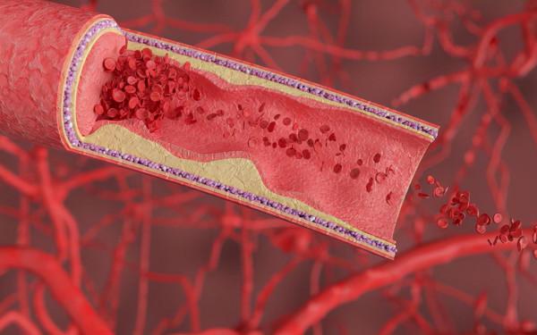 什麼是皮下出血？皮下出血是紫癜嗎？
