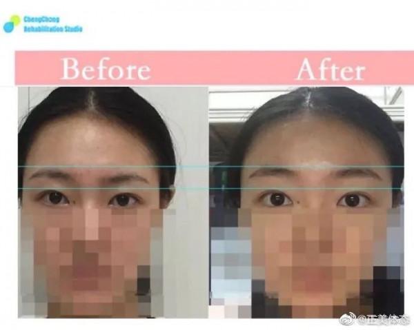 同在一張臉上兩隻眼睛高度卻不同呢? 同在一張臉上兩隻眼睛高度卻不同呢?