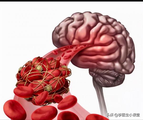 長期服用阿司匹林和他汀，是在治療腦梗死嗎？它的真正目的是什麼