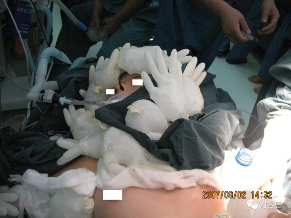 惡性高熱第1例:2007年西京醫院術中“惡性高熱”一例 惡性高熱第1例:2007年西京醫院術中“惡性高熱”一例