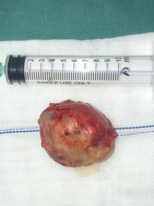 雞蛋大的頸部腫瘤經口取出-內鏡下經口咽旁間隙腫瘤切除術