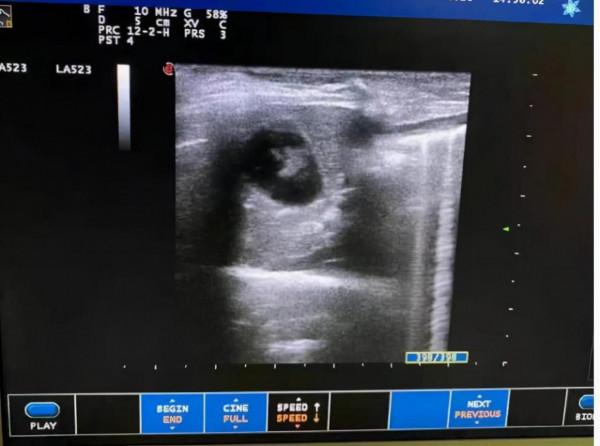 狗子膽泥膽沙膽結石，應該怎麼治療？