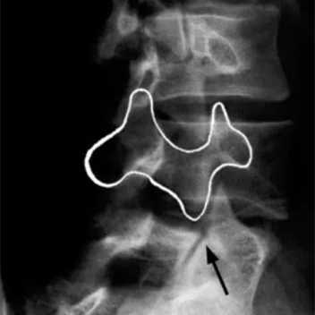 腰椎斜位X片上的“狗”症