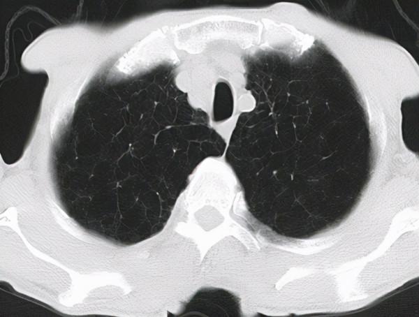 72歲老年男性，從深受慢阻肺折磨到諸症均安，他經歷了什麼？
