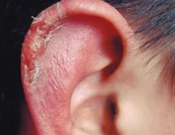 科普三分鐘丨冬天到了小心凍傷