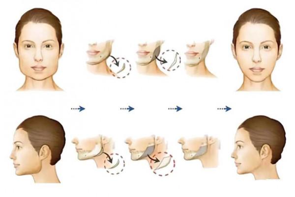 這些年削骨的女明星臉還好嗎?後遺症一大堆,有些都開始崩了 這些年削骨的女明星臉還好嗎?後遺症一大堆,有些都開始崩了