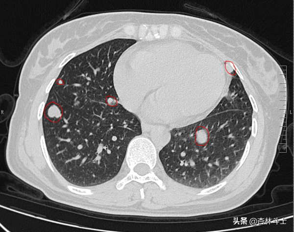 中年女性，兩年連續多次預警不重視，再次檢查發現腫瘤已是晚期了