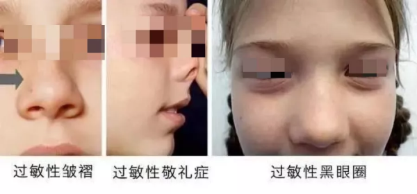 孩子打噴嚏、流鼻涕就一定是感冒？