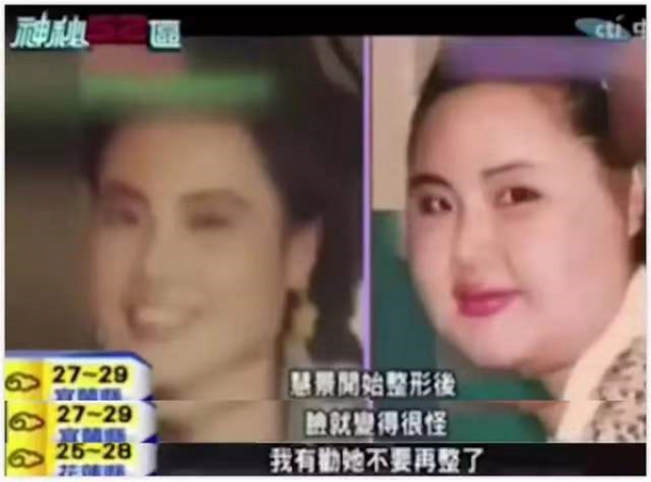 “整容上癮”韓慧景：把臉整成電風扇，自行注射食用油，代價慘痛