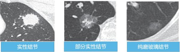 發現肺結節後，離肺癌還有多遠？