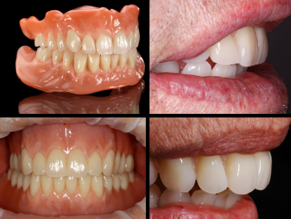 假牙的種類及價格，你知道嗎？