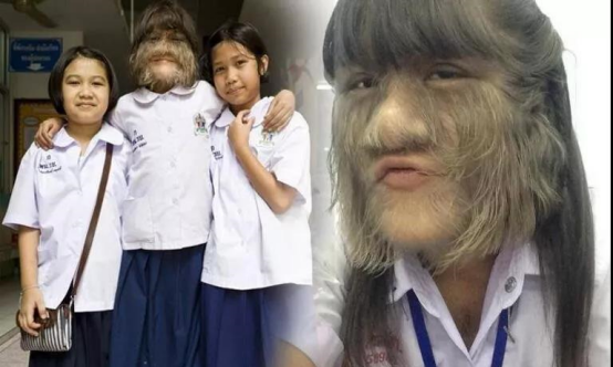 泰國女孩臉上長滿毛髮，長相特殊受盡嘲諷，父母卻視她為掌上明珠