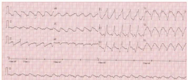 室性心律失常的新進展,你瞭解多少?|GW-ICC 2021 室性心律失常的新進展,你瞭解多少?|GW-ICC 2021