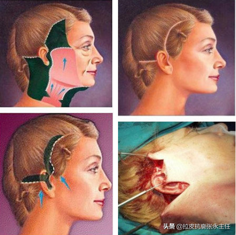 小切口拉皮除皺術真的能維持10年？