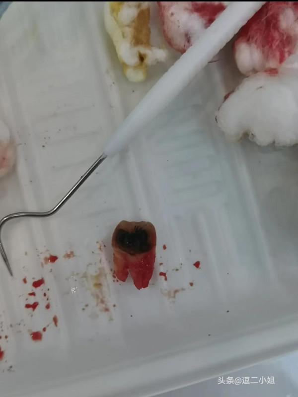 拔牙的經歷
