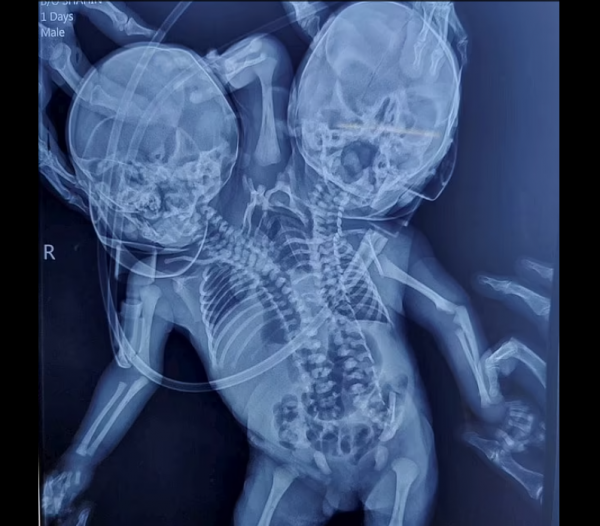 機率僅有百萬分之一！印度女子產下胎兒似“哪吒”，醫生直呼罕見