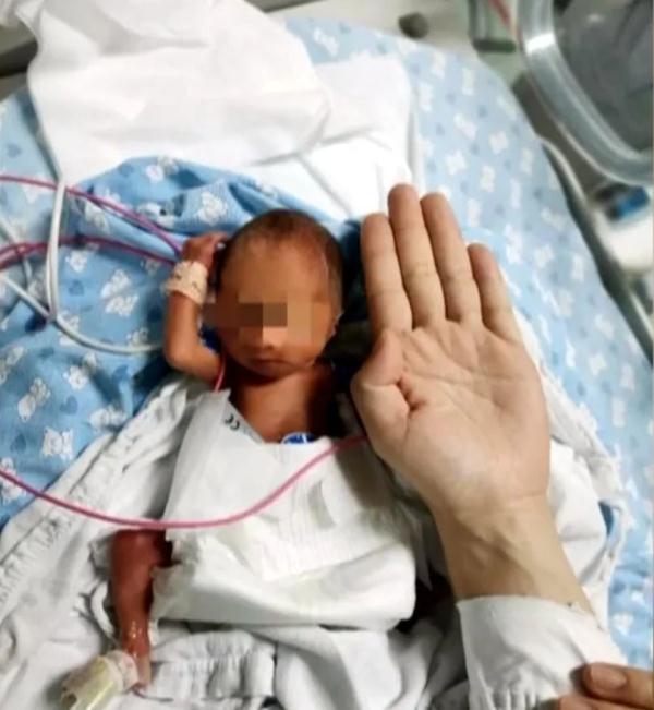 闖關加油啊！出生僅1斤多超早產寶寶奇蹟存活