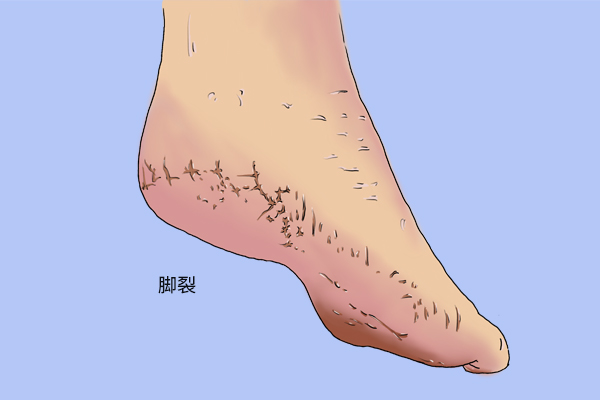 肝臟病變並不沉默，面板出現3種變化，別以為是面板問題